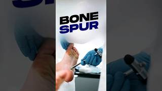 How Arthritis Leads to Cartilage Wear Bone Spurs and Joint Calcification [upl. by Gnaht810]