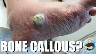 HUGE CALLOUS DUE TO COLLAPSED ARCH EXTREME CALLOUS REMOVAL [upl. by Maggio908]