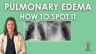 Pulmonary Edema Chest Xray [upl. by Chastity]