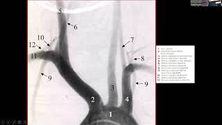 Angiografia cerebral normal Dr Angel Ferrario [upl. by Yadahs]