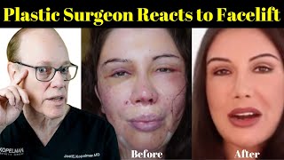 Plastic Surgeon Reacts  Lorry Hills Facelift Before amp After [upl. by Koller]