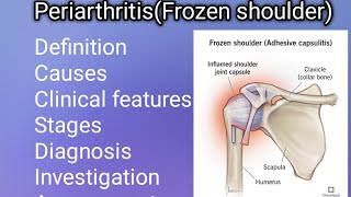 PeriarthritisFrozen shoulderEasy Notes PT Arthopedic condition  Assessment amp PT Management [upl. by Ringsmuth]