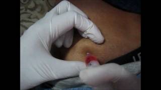 How To Give An IM Injection At Buttocks amp Choose Site For Injection [upl. by Okimik843]