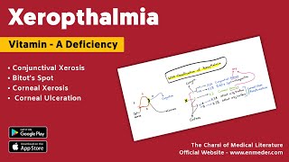 Xerophthalmia  Vitamin A deficiency  WHO Classification [upl. by Olnek]