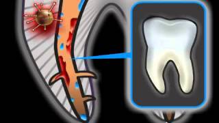 Root Canal Complications in Dentistry [upl. by Cohette]