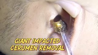 Giant Impacted Cerumen Removal [upl. by Yard]