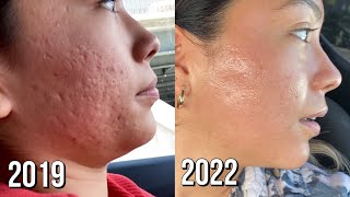 Microneedling Session 8 Before  After [upl. by Arias576]