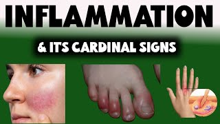 inflammation cardinal signs  inflammation [upl. by Crifasi49]