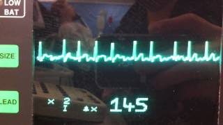 Atrial fibrillation ECG [upl. by Nefen]