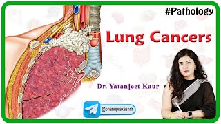 Lung Cancers Pathology In Hindi  Benign and Malignant   MBBS USMLE Neet PG and FMGE [upl. by Deeanne]