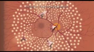 Laser Procedure for Proliferative Diabetic Retinopathy  Eye Associates of CO Springs [upl. by Jane]