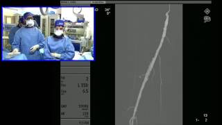 Transradial Access for Above the Knee SFA Angioplasty and Stenting [upl. by Zoltai]