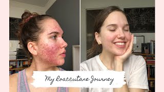 Roaccutane  My 6 Month Journey to Clear Skin [upl. by Alma]