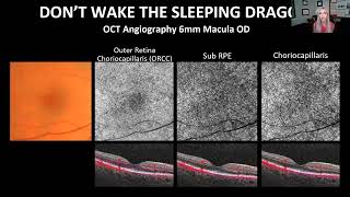 Mastering OCT Interpretation Through Case Analysis [upl. by Haven]