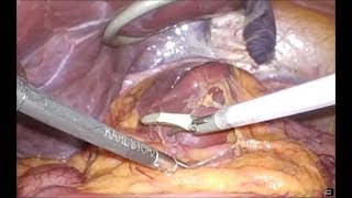 Laparoscopic Caudate Lobectomy [upl. by Kalman180]