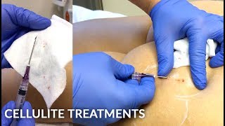 No Pain Affordable Buttock Cellulite Treatment With Subcision amp Bellafill Injections  Dr Jason Emer [upl. by Aneek]