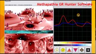 Atheromatous Aorta Medicomat Aorta Treatment [upl. by Mady]