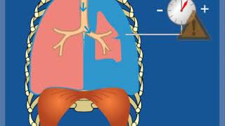 Loch in der Lunge Ventilpneumothorax – Grundlagen  Thoraxdrainage für Einsteiger [upl. by Lorenzana]