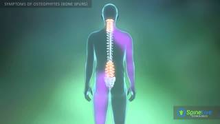 Osteophytes bone spurs Symptoms [upl. by Ida561]