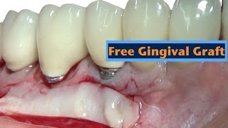 free gingival graft [upl. by Aicia]