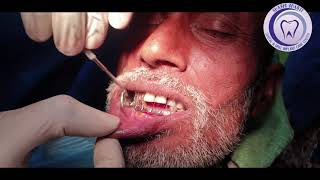 Fractured condyle of mandible  Dr Rajkumar R Choubey MDS  Dentist Ghazipur  Dentist Varanasi [upl. by Orgalim]