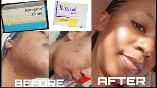 HOW I GOT RID OF MY ACNE  ACNETANE amp TETRALYSAL [upl. by Tremaine30]