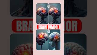 quotBrain Tumor Awareness Symptoms Diagnosis and Treatmentquot By OperationTheatreSKR BrainTumour [upl. by Eldwen144]