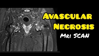 Avascular necrosis  Osteonecrosis  MRI HIP JOINT  Radiology [upl. by Atikam492]