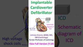 Implantable Cardioverter Defibrillator [upl. by Alyn622]