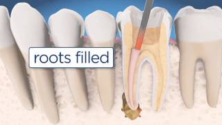 Root Canal Retreatment Explained [upl. by Mcnally425]