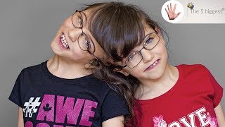 Do conjoined twins share thoughts Unbelievable facts  Body Bizarre [upl. by Truscott]