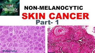 SKIN CANCER Non Melanocytic Part 1 Anatomy Etiopathogenesis amp Classification [upl. by Akinahc]