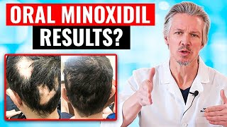 20000 PEOPLE TOOK ORAL MINOXIDIL AND THIS HAPPENED [upl. by Hoffman]