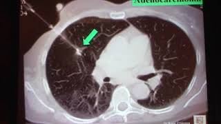 15 Neoplasie del Polmone Le biopsie polmonari Giancarlo Bosio [upl. by Espy]