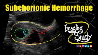 Subchorionic Hemorrhage  Ultrasound  Case 258 [upl. by Anceline]