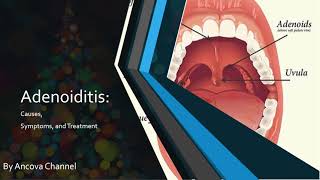 Adenoiditis PowerPoint presentation [upl. by Ulick]