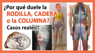 Dolor de Rodilla Espalda y Cadera 🛑 Descubre las Causas REALES con Casos REALES 🤯 [upl. by Ynaffi]