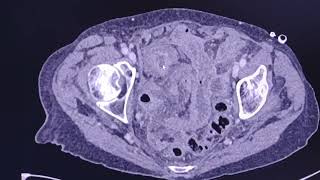 Small bowel obstruction due to 2 different causes Unusual case CT findings [upl. by Paris]