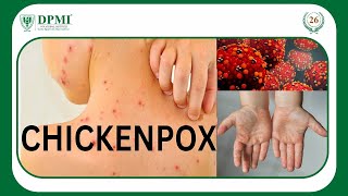 Chicken Pox Varicella What is the Cause of Chickenpox ChickenpoxSymptoms Treatment amp Prevention [upl. by Arrad]