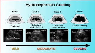 Hydronephrosis Ultrasound Grading [upl. by Anaahs]