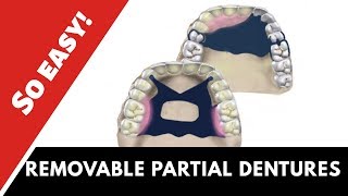 Partial dentures  ɪɴᴅɪᴄᴀᴛɪᴏɴꜱ amp ᴄᴏɴᴛʀᴀɪɴᴅɪᴄᴀᴛɪᴏɴꜱ [upl. by Yerxa]