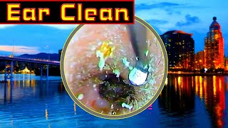 Ear wax removal Ear Cleaning Ear wax [upl. by Nilcaj]