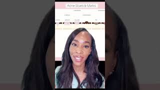 HOW TO REDUCE ACNE SCARS [upl. by Gilbertine]