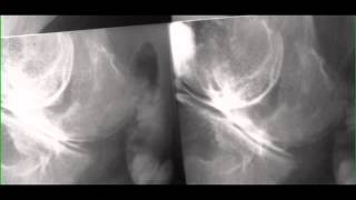 Medial Meniscus Tear on Arthrogram [upl. by Stern620]