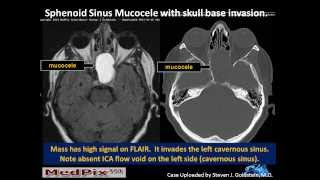 Sphenoid Sinus Mucous Retention Cyst vs Mucocele [upl. by Arabela5]