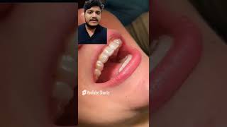 Fixed retainers after orthodontic treatment trending hospital dentalschoollife viralvideo [upl. by Noit100]