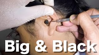 Big Black Earwax STUCK in Young Womans Ear Removed [upl. by Damita478]