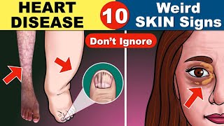 10 Skin Signs of Heart Disease  Coronary Artery Disease  Heart Attack [upl. by Inger]