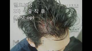 밀도보강 성공 모발이식 1차2차 영상 2차 FUE Hair transplantation by Dr Moh 2ndary case [upl. by Ahseid]