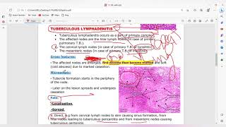 Non neoplastic lymhoma [upl. by Parthinia]